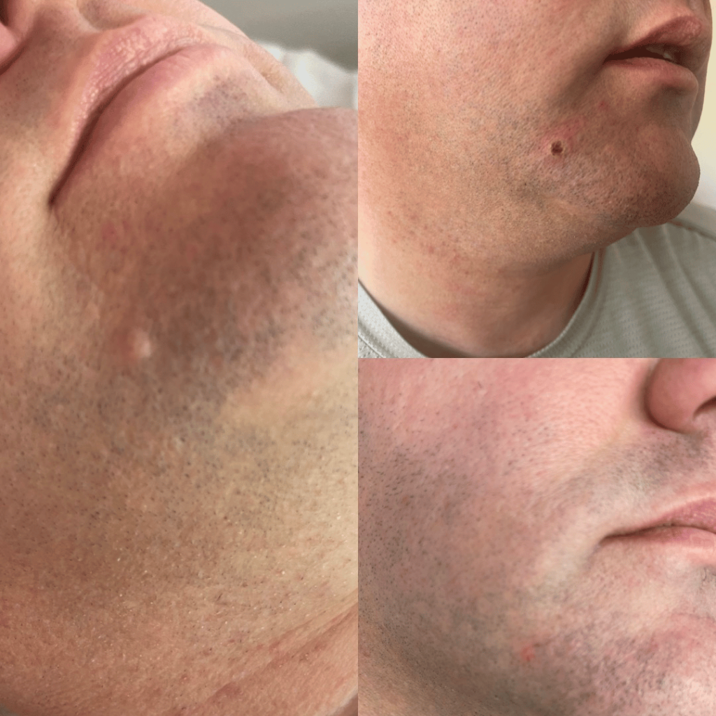 Skin Tag Removal Thornbury