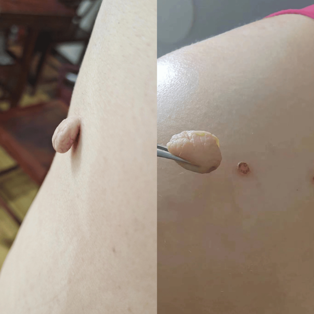 Skin Tag Removal Thornbury