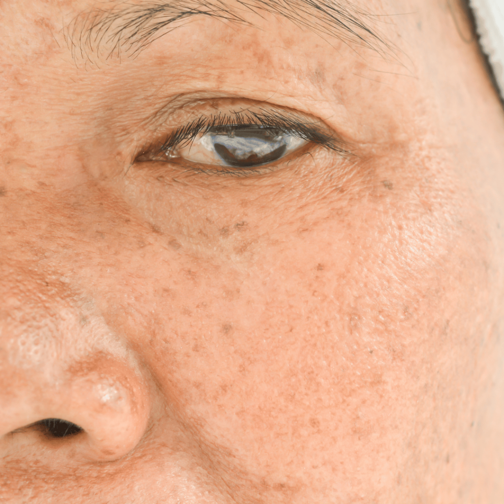Freckle Removal Thornbury