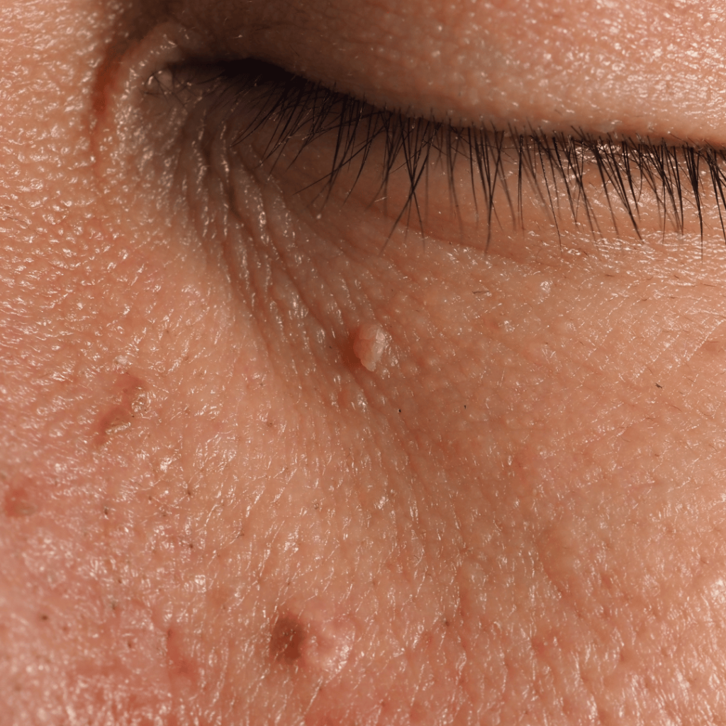 Wart Removal Thronbury